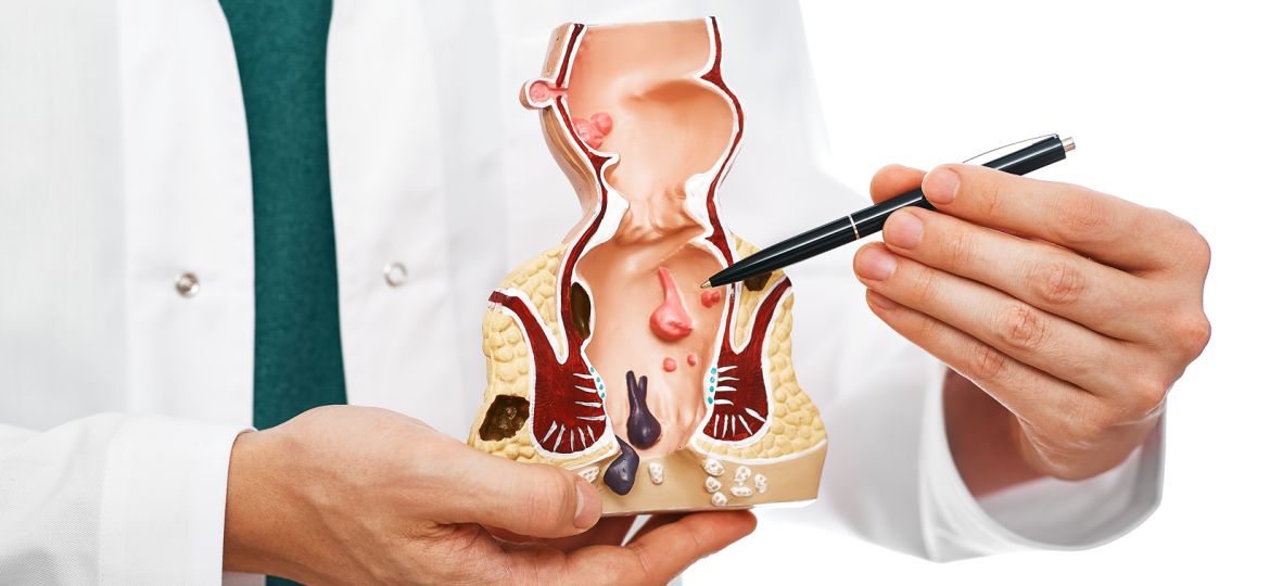 Treatment of rectal diseases, hemorrhoid. Proctologist pointing pen rectum pathologies on an anatomical model