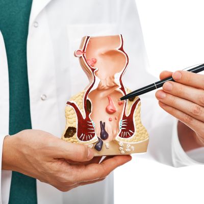 Treatment of rectal diseases, hemorrhoid. Proctologist pointing pen rectum pathologies on an anatomical model