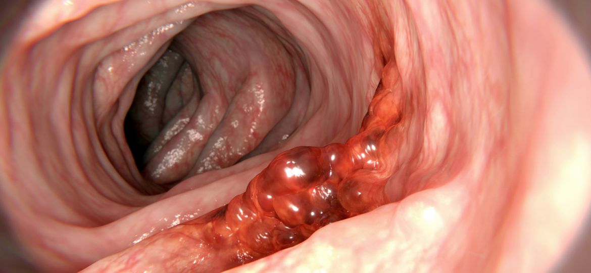 Colorectal cancer