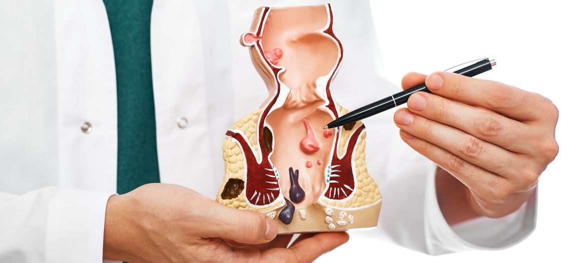 Treatment of rectal diseases, hemorrhoid. Proctologist pointing pen rectum pathologies on an anatomical model