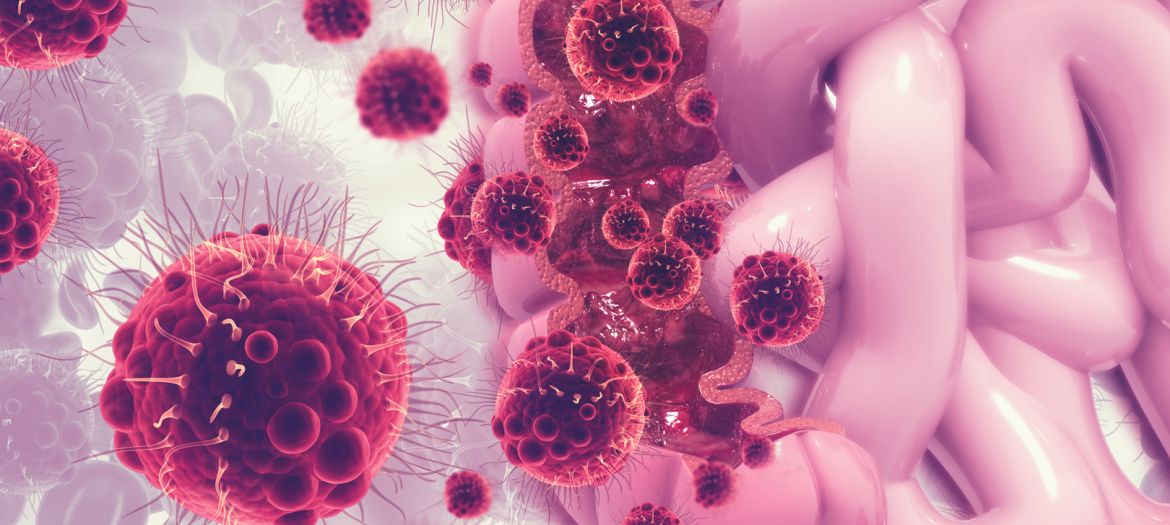 Colon cancer. Cancer attacking cell. Colon disease concept. 3d illustration